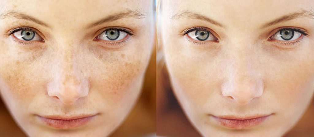 کرم تخصصی ضد لک دستساز؛ راهحلی طبیعی و موثر برای پوستی بیلک
